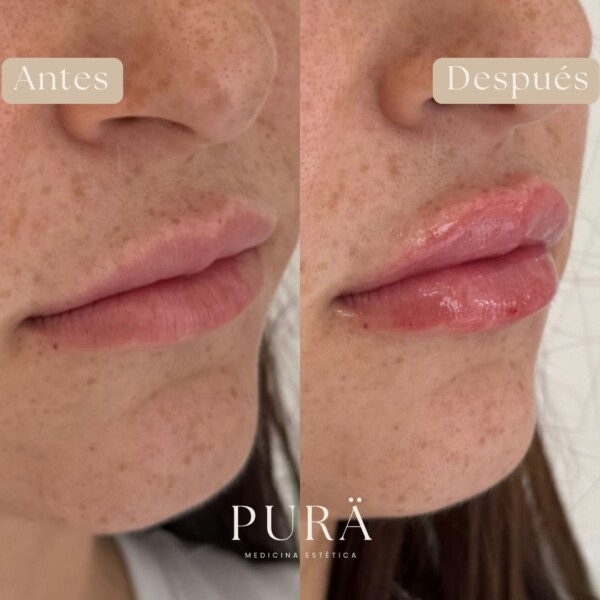 ✨ Belleza naturalmente potenciada ✨En PURÄ Medicina Estética creemos en resaltar lo mejor de ti, sin exageraciones. 💋 Con una técnica cuidadosa y productos de alta calidad, logramos un volumen y definición que mantienen la armonía y naturalidad en tu rostro.

📸 Swipe para ver el increíble antes y después de este tratamiento. Cada detalle cuenta para crear un look personalizado y sofisticado.

¿Te gustaría saber más sobre cómo podemos ayudarte a lograr unos labios que se adapten a ti? Escríbenos, ¡estamos aquí para guiarte!

 medicinaesteticamalaga purämedicinaestética puramedicinaestetica aumentodelabiosmalaga lipfillermalaga