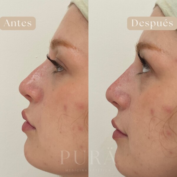 ✨ Descubre la magia de la rinomodelaciónEn PURÄ, creemos que los pequeños cambios pueden hacer una gran diferencia. Con técnicas avanzadas y productos de primera calidad, logramos resultados naturales que armonizan tus facciones, realzando tu belleza sin perder tu esencia. 💫

¿Quieres darle un toque de equilibrio y simetría a tu perfil? La rinomodelación es una opción perfecta para quienes buscan mejorar sin recurrir a la cirugía.

Natural. Elegante. Tú, en tu mejor versión. 💫

 purämedicinaestética puramedicinaestetica medicinaesteticamalaga rinomodelacion rinomodelacionmálaga rinomodelacionmalaga
